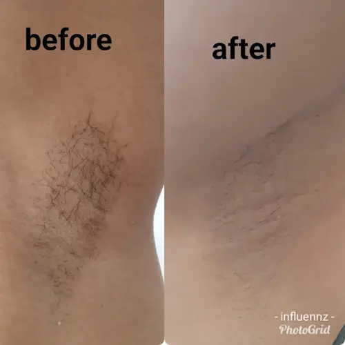underarm pigmentation before and after result