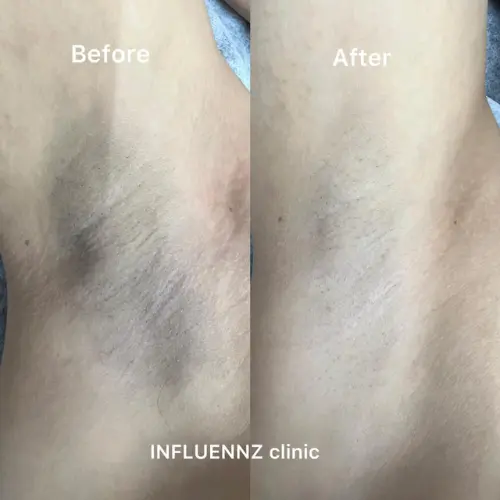 can glutathione whiten underarm Reveal brighter and smoother underarms with our L-Glutathione Duo ✨  Confidence starts with bright underarms! 💖 Shop conveniently at Watsons  in-store or online! #CathyDollPh #WatsonsPH
