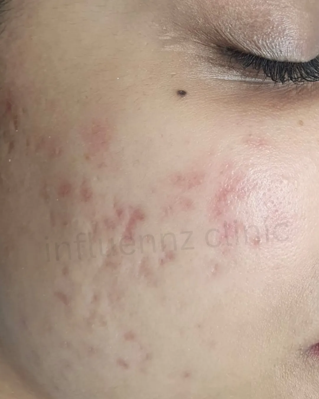 Before Acne Scar