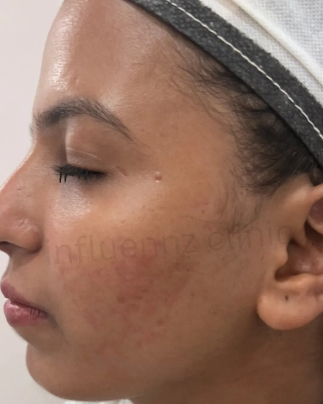 Before Acne Scar