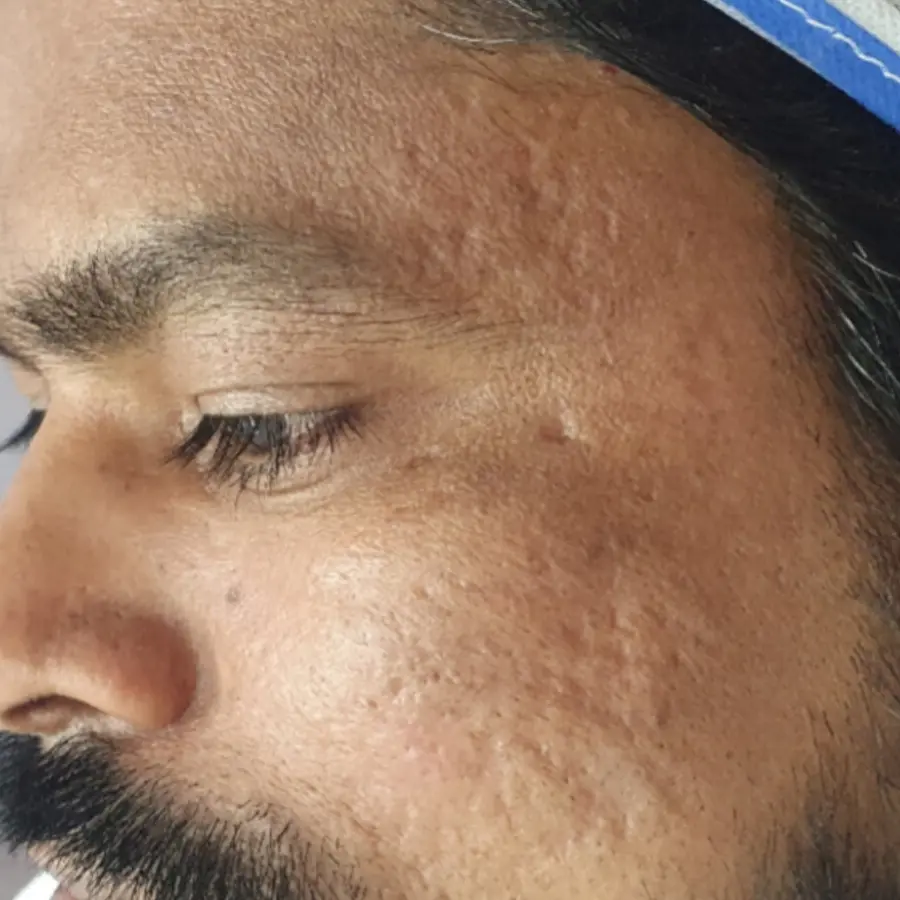Before Acne Scar