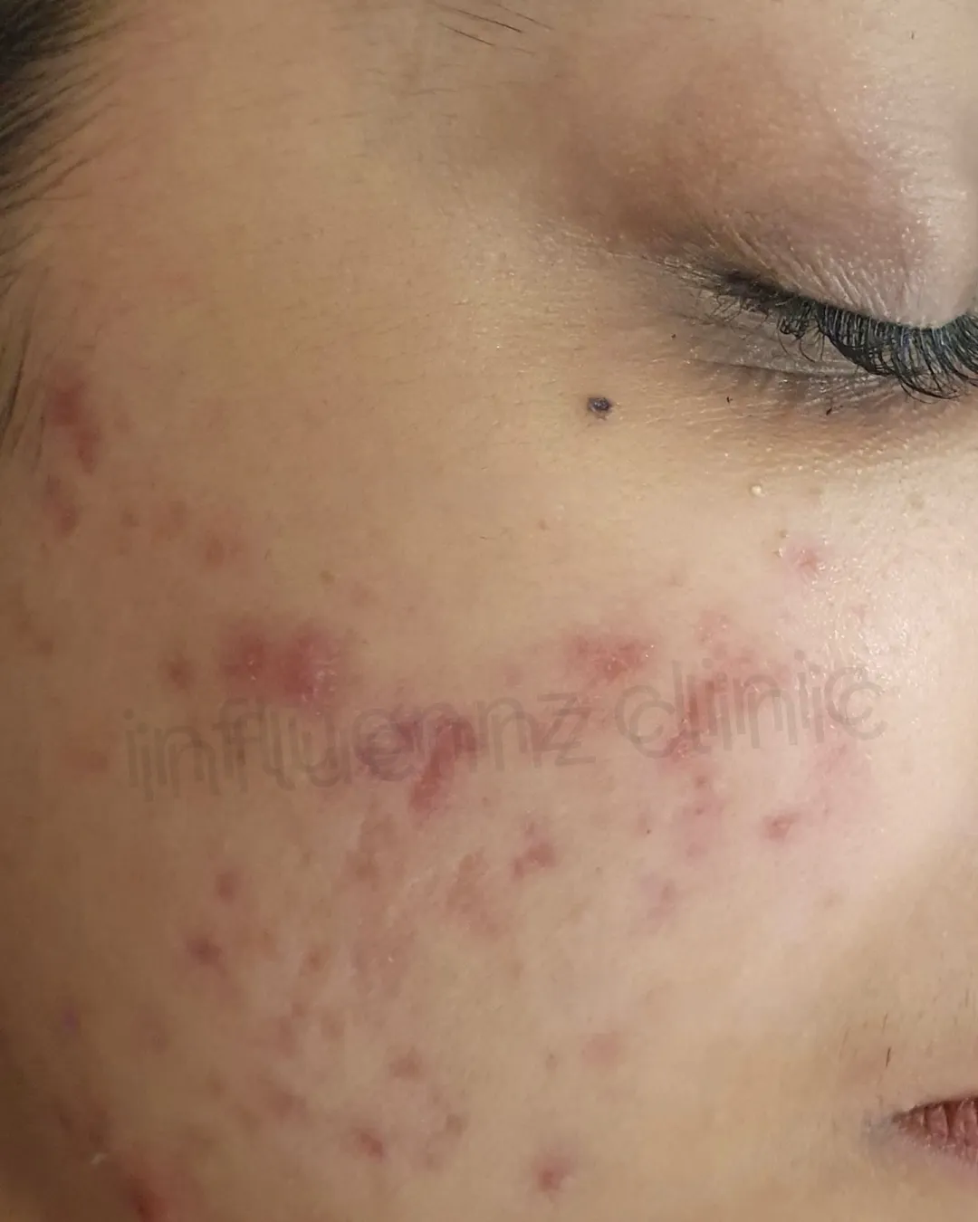 After Acne Scar