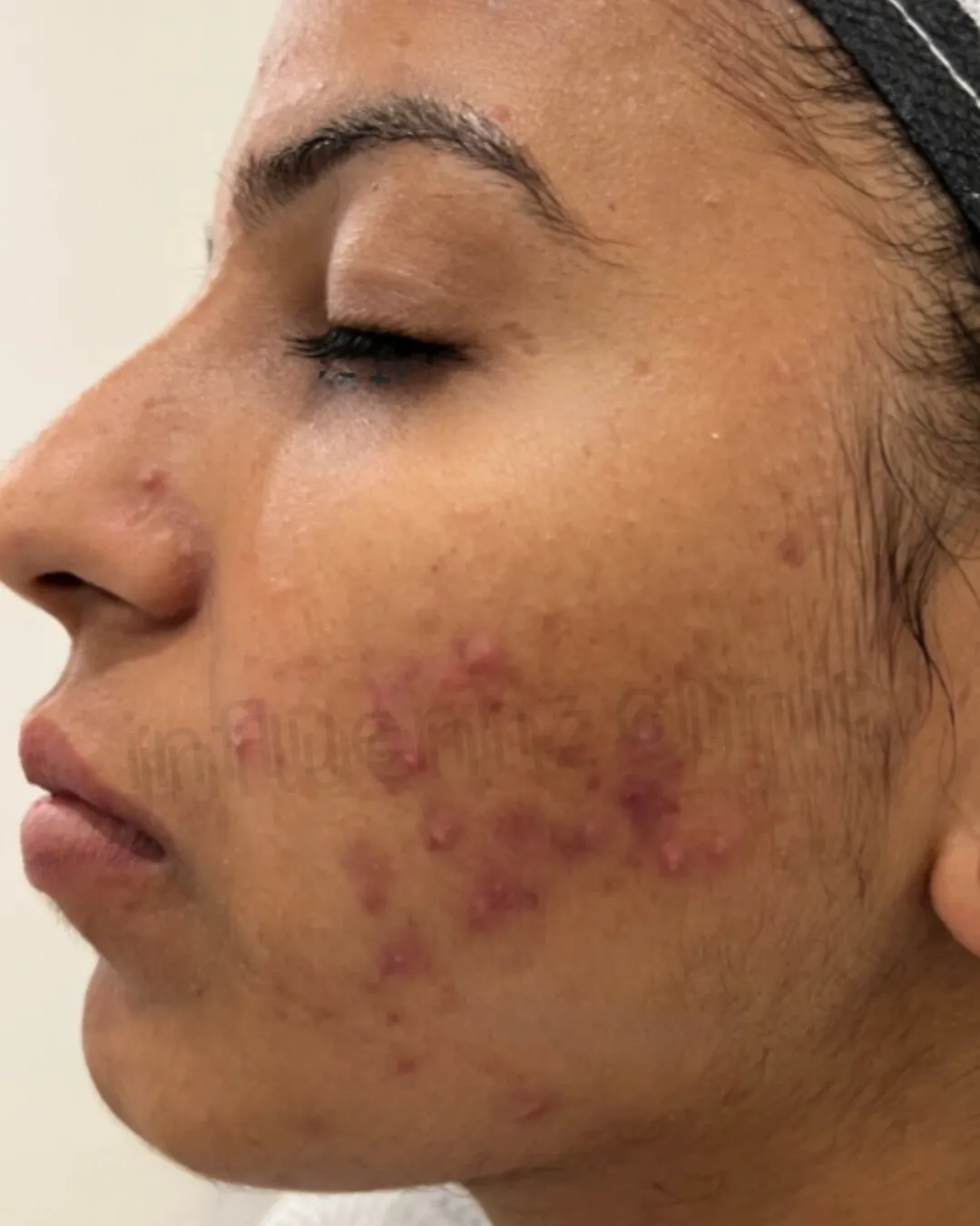 After Acne Scar