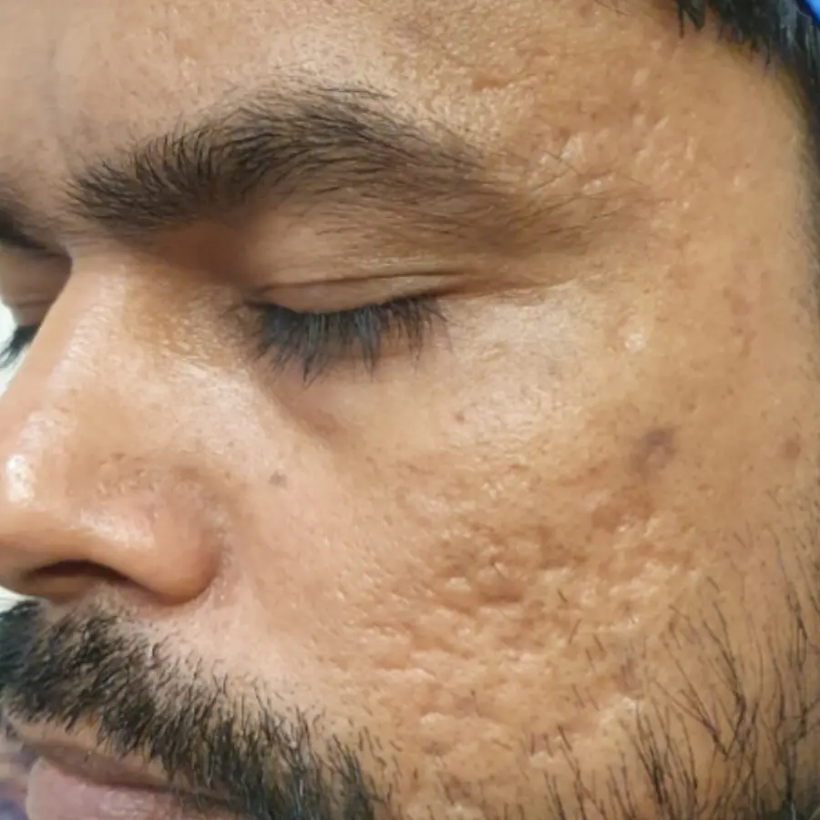 After Acne Scar