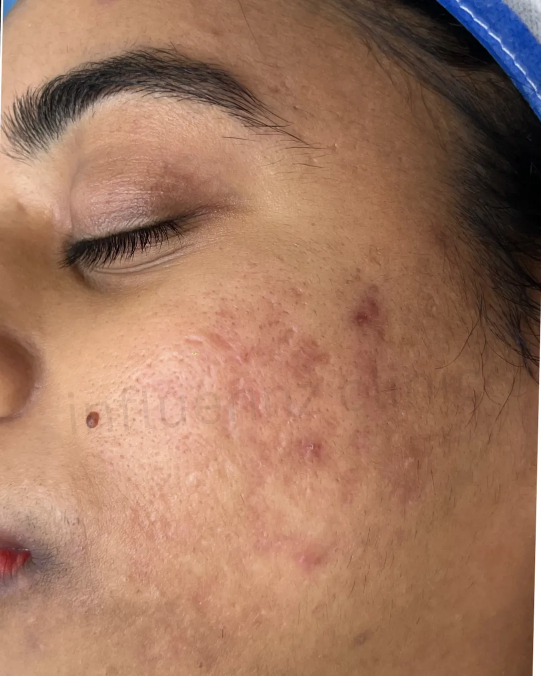 Before Cheek Filler