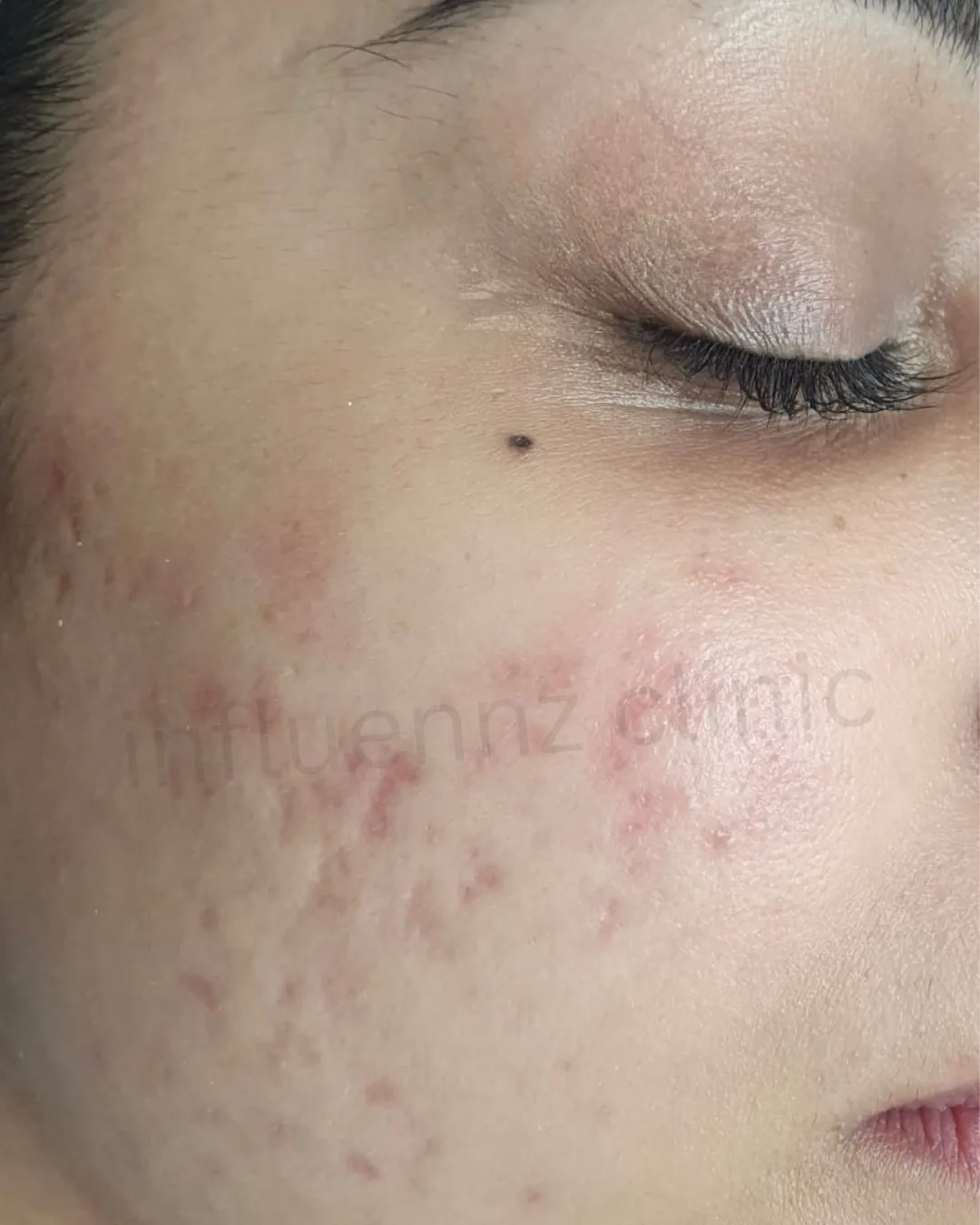 Before Chin Filler