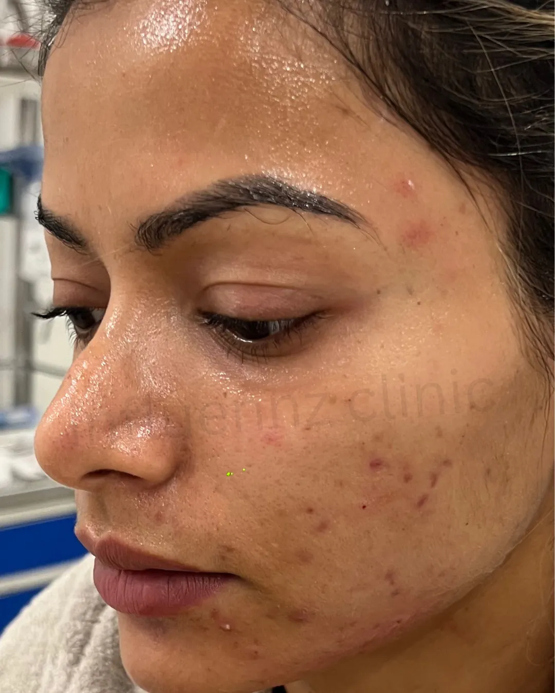 After Hand Rejuvenation