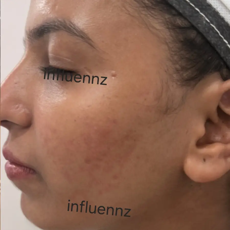 Before Hand Rejuvenation