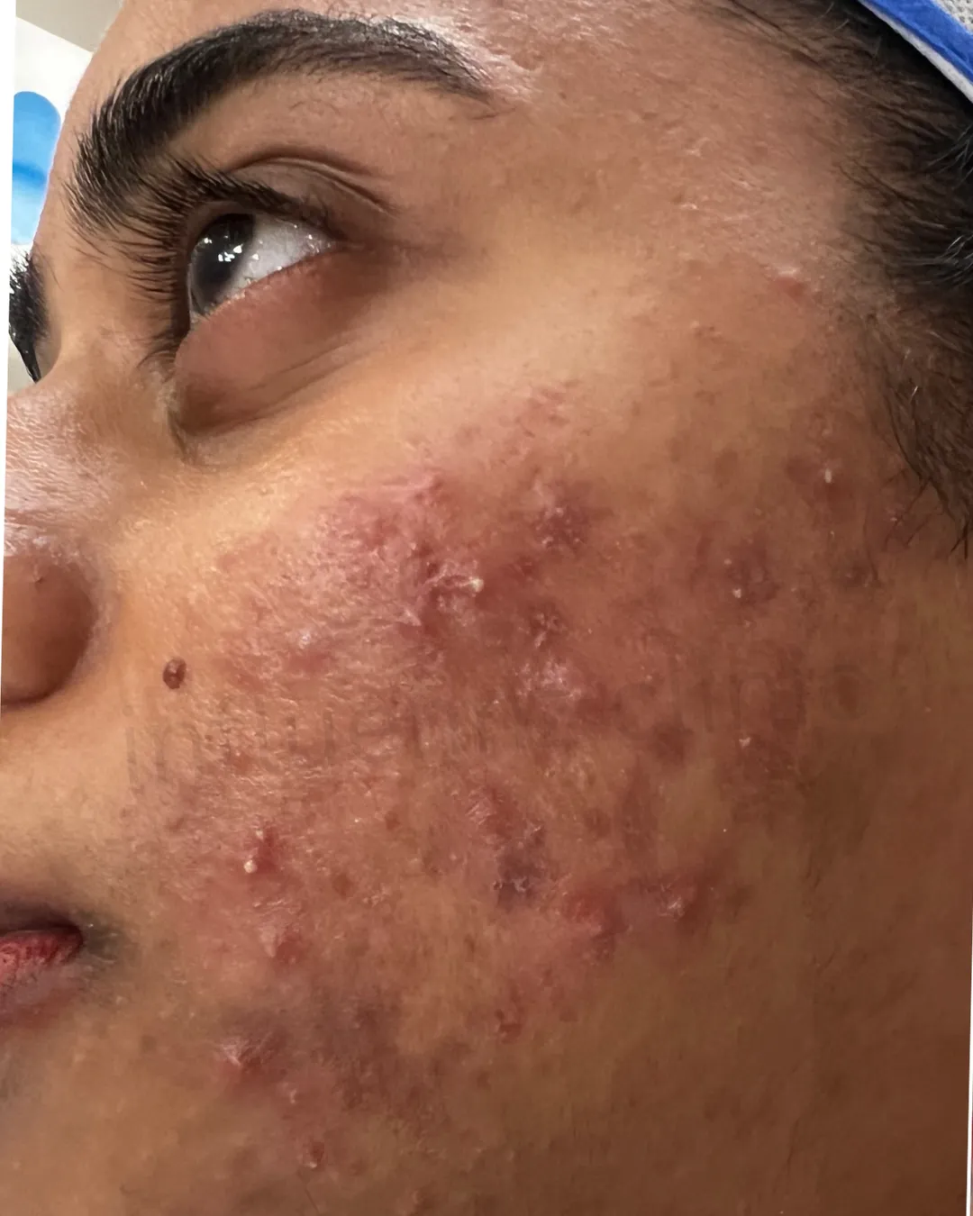 After Cheek Filler