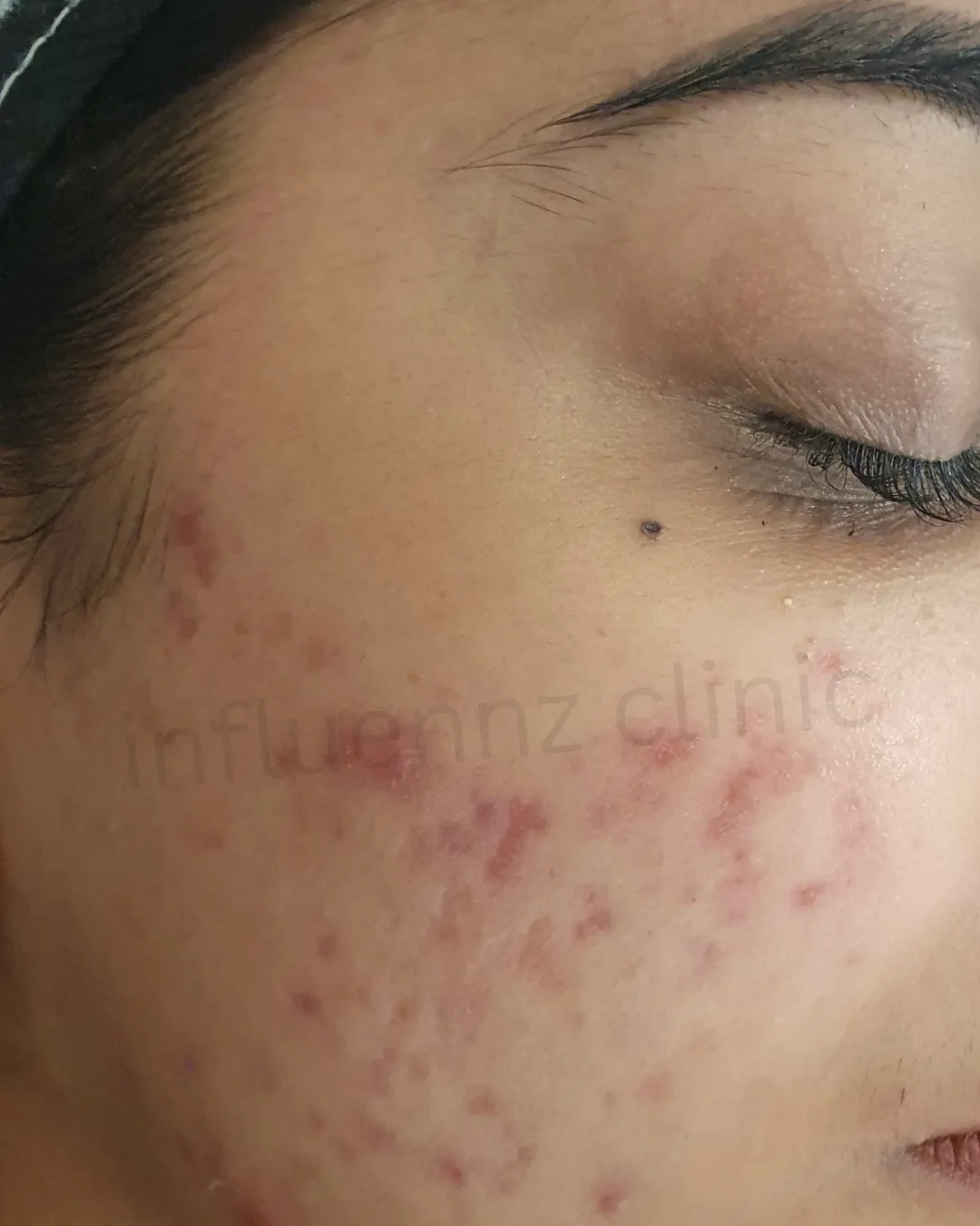 After Chin Filler
