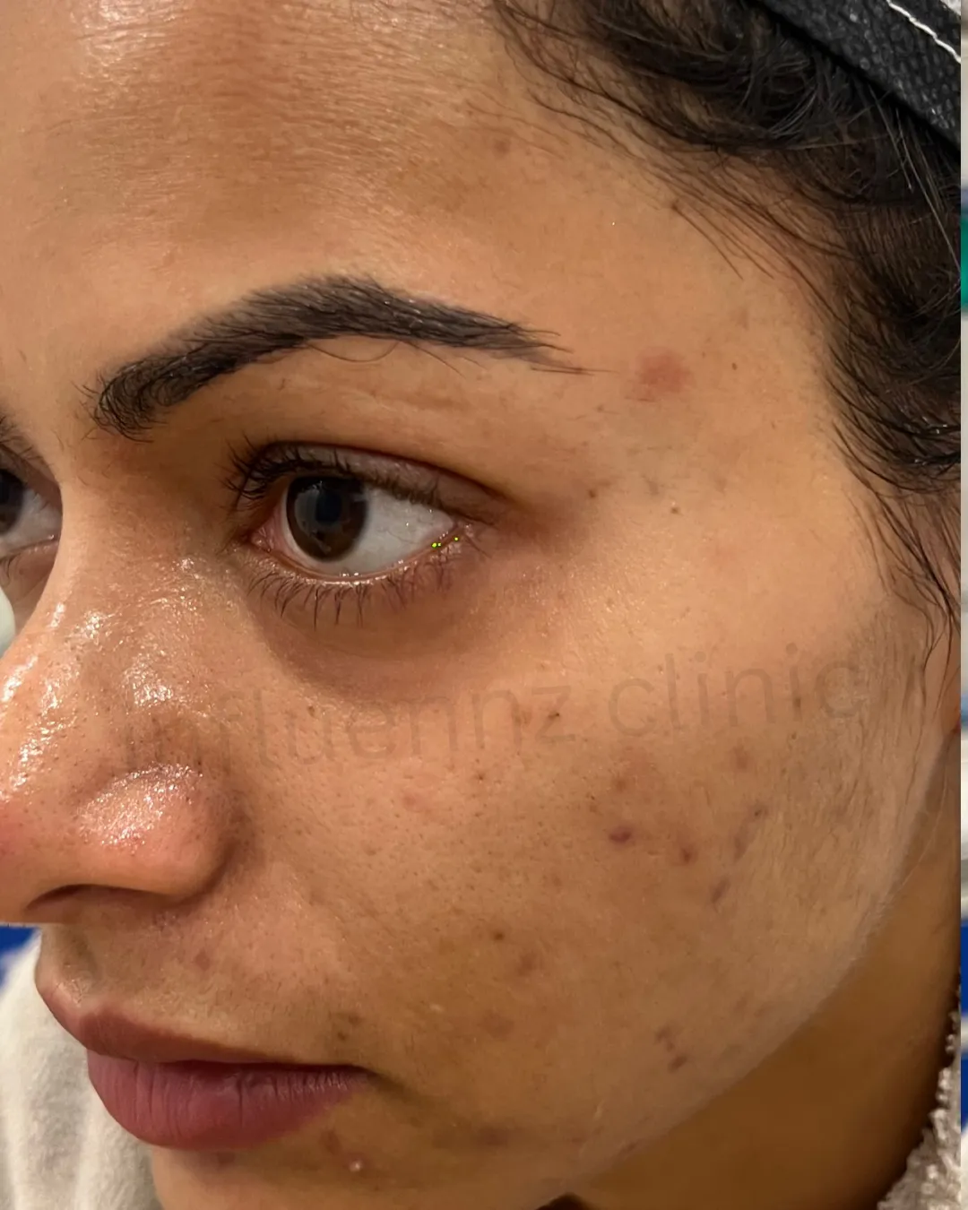 Before Hand Rejuvenation