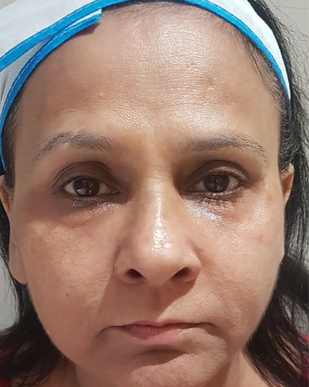 After Anti Aging