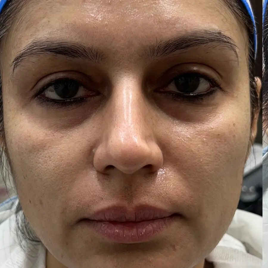After Anti Aging