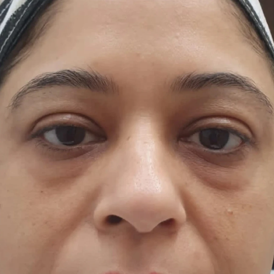 After Anti Aging