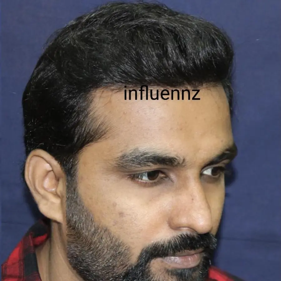 Before Melasma