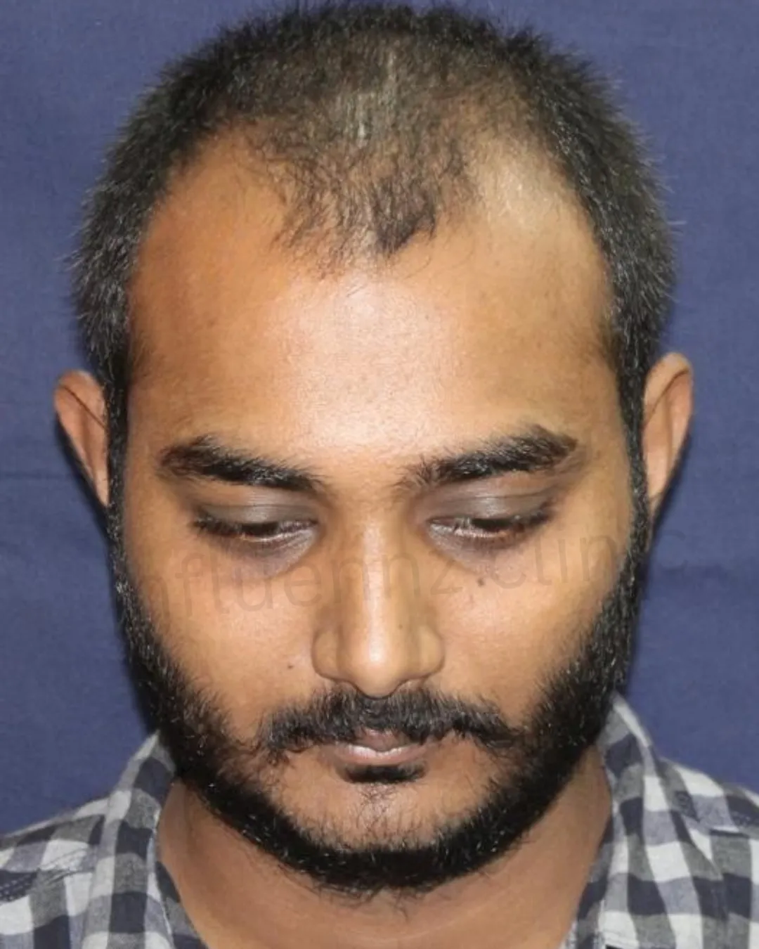 After Melasma