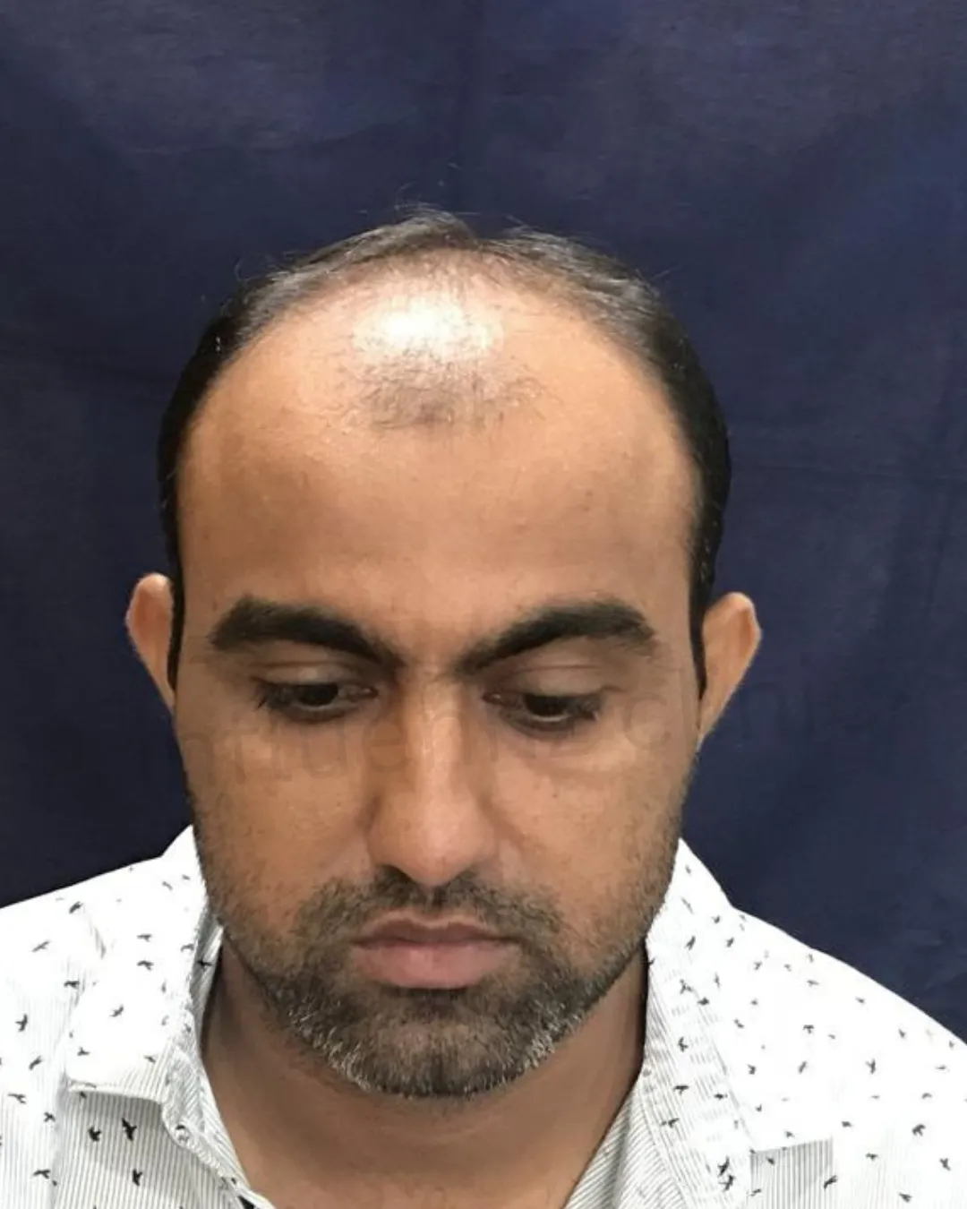 After Melasma