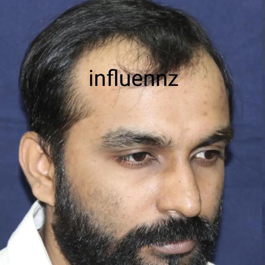 After Melasma