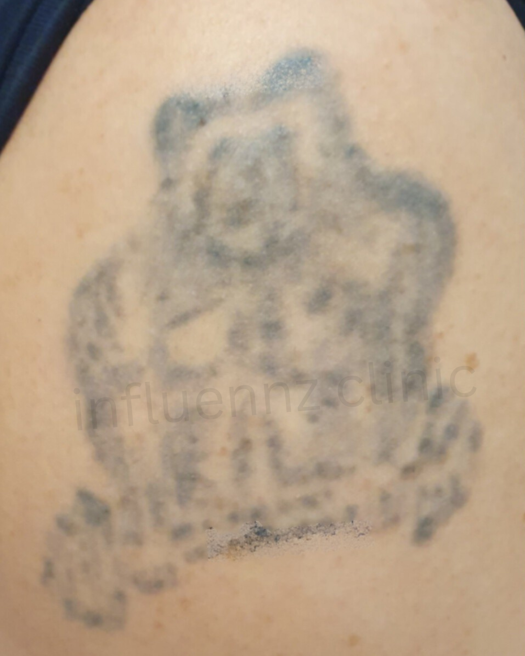 After Tattoo