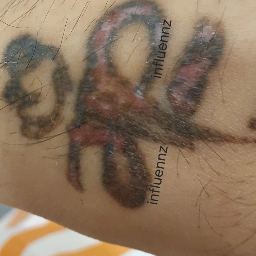 After Tattoo