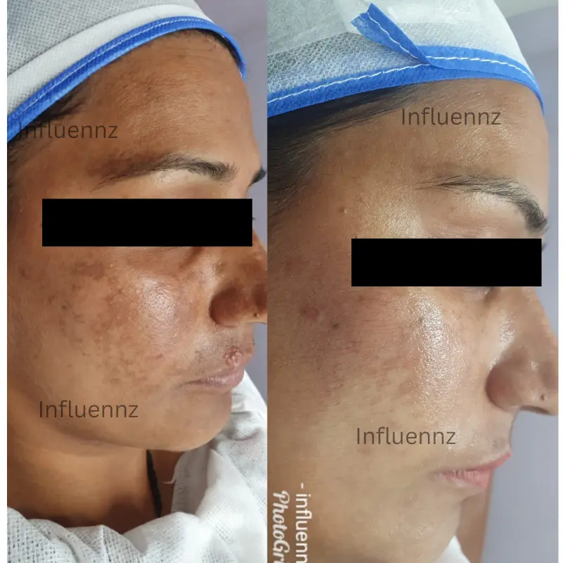 Pigmentation before and after result