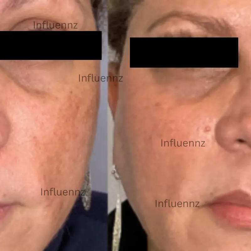 Pigmentation treatment transformations