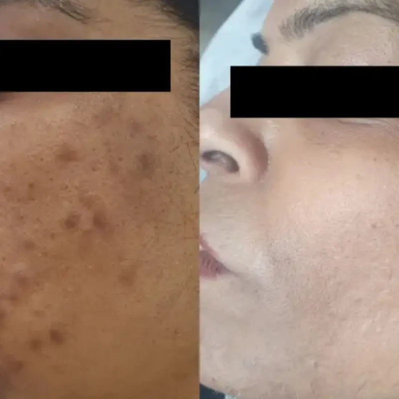 Pigmentation result