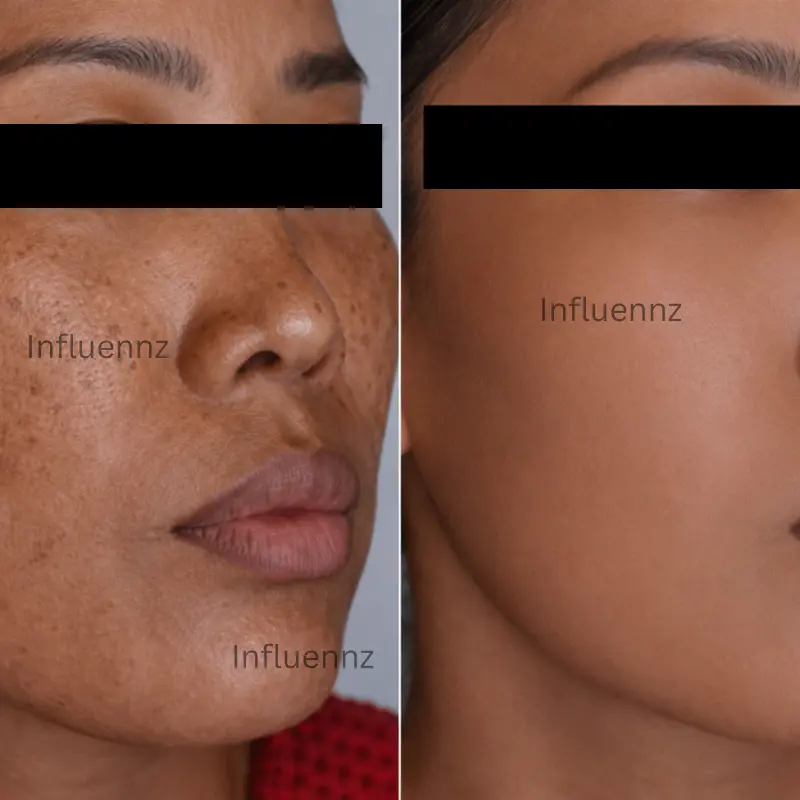 Pigmentation before and after treatment result