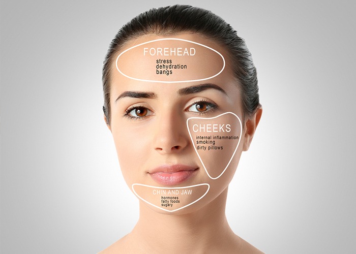 Acne treatment  in Delhi