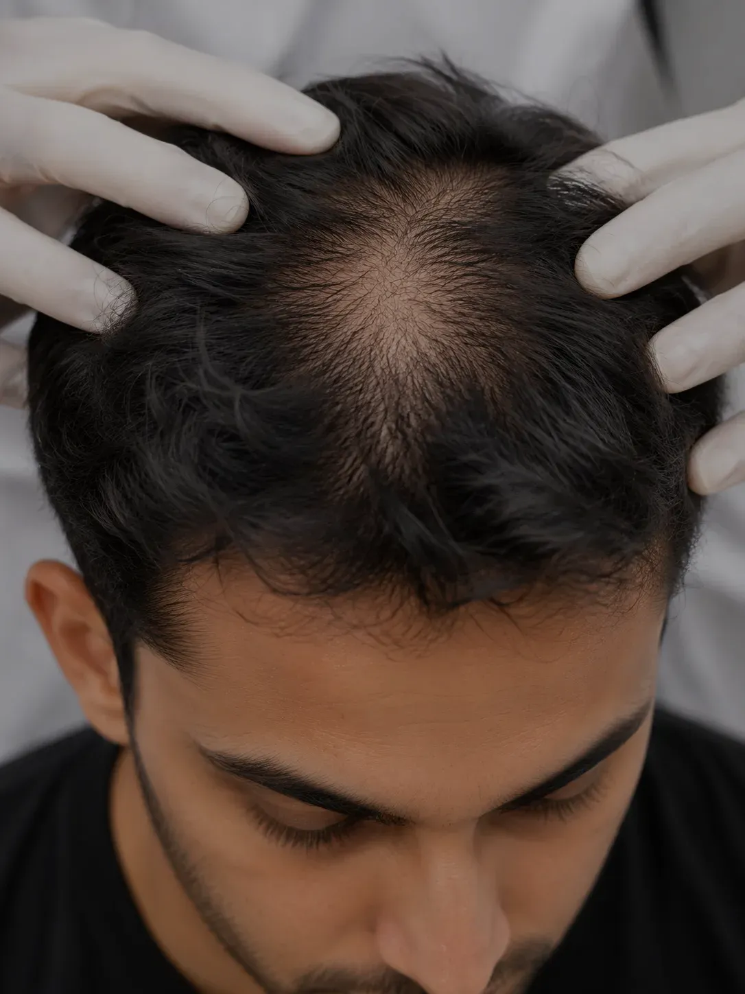 Hair Loss