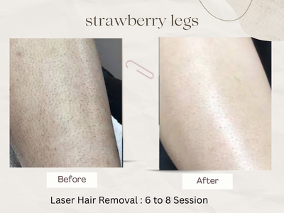 Laser Hair Removal before and after photos