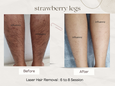 Laser Hair Removal before and after photos