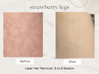 Laser Hair Removal before and after photos