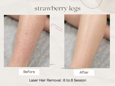Laser Hair Removal before and after photos