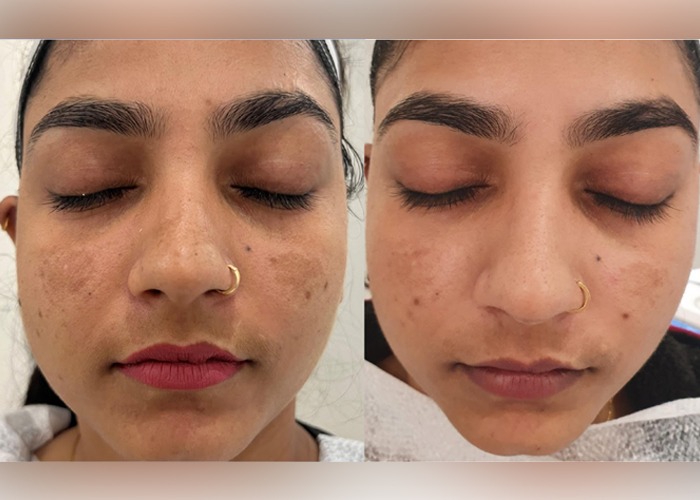 Best Melasma Treatment in Delhi Influennz Clinic