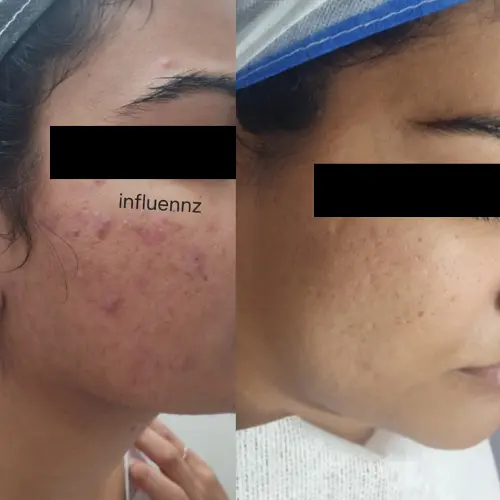 acne before after result