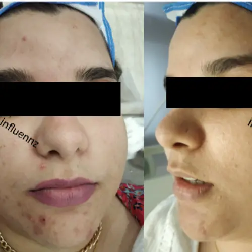 acne treatment result delhi