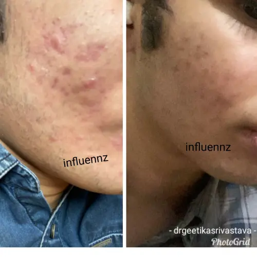 Acne before After  result