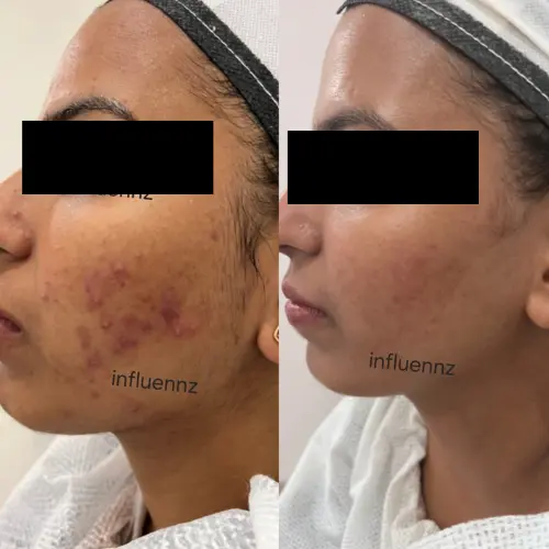 Acne  before after transformation