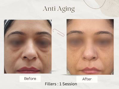 Anti-ageing treatment before after