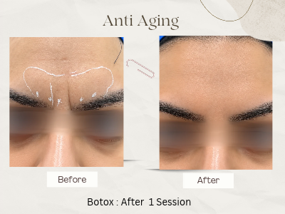 Anti-ageing result Delhi