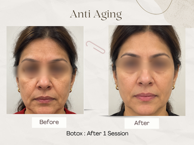 Anti-ageing skin rejuvenation result