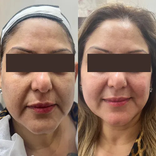 botox before and after result