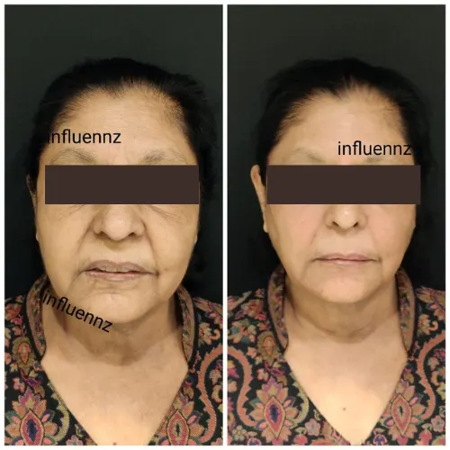 botox before after