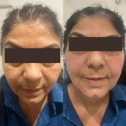 botox treatment result delhi