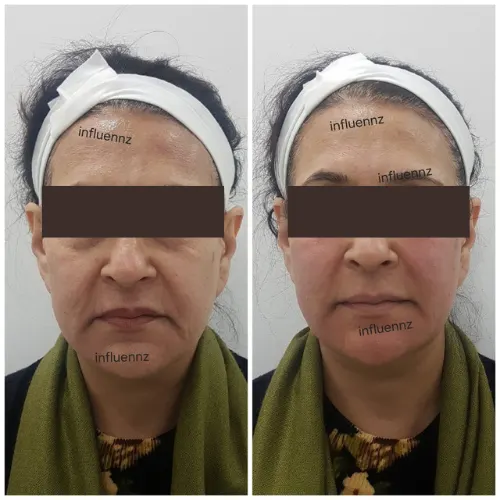botox before and result