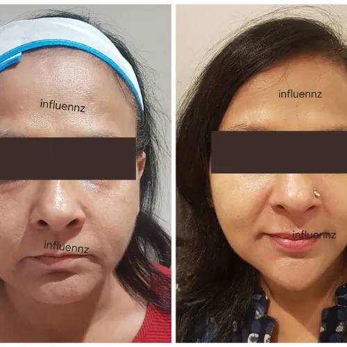 botox treatment before after result delhi
