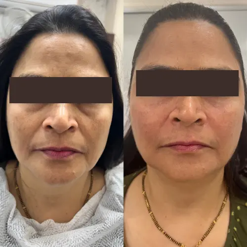 botox before after delhi