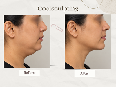 CoolSculpting body contouring before and after result