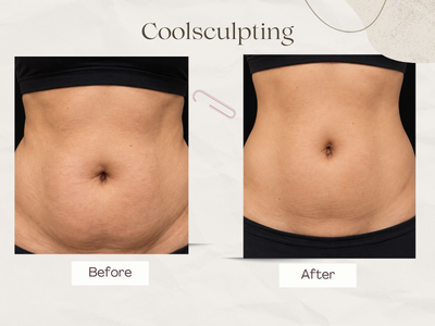 Fat freezing inch loss result